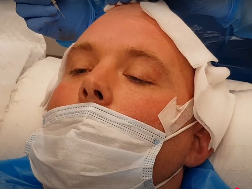 Tubes during his 2020 hair transplant