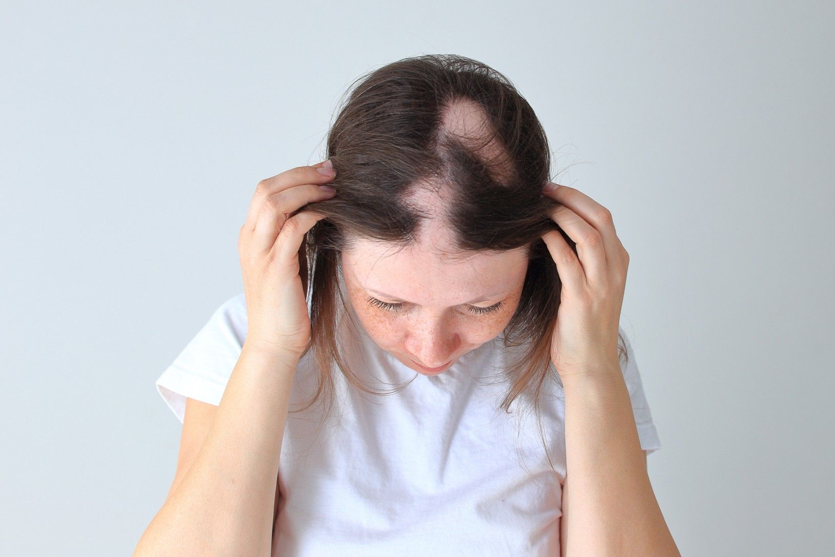 Woman with alopecia areata