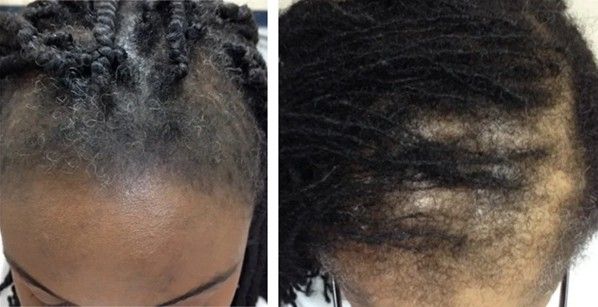 Women with traction alopecia