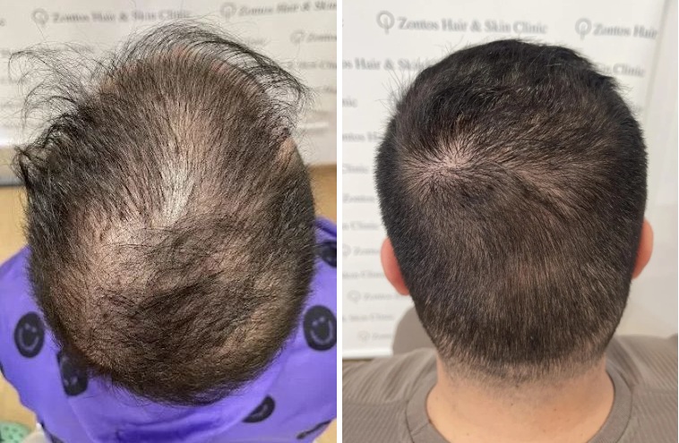 bad hair transplant from a Greek black market hair transplant clinic