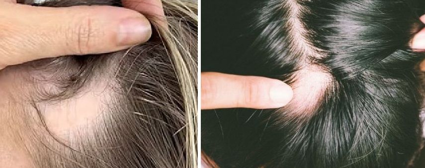 congenital triangular alopecia vs alopecia areata