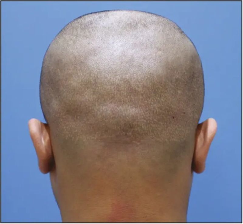 Pinpoint scars from FUE hair transplant surgery