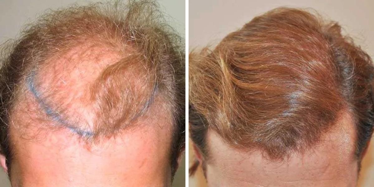 bald hair transplant example 1