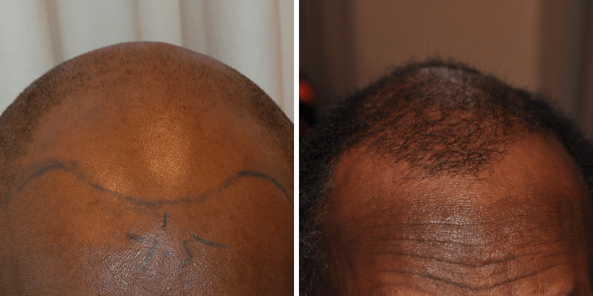 Is It Too Late For A Hair Transplant?, Wimpole Clinic