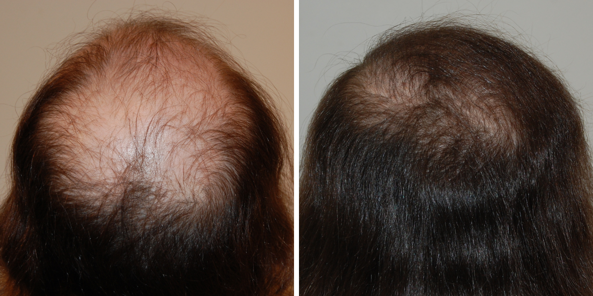 Is It Too Late For A Hair Transplant?, Wimpole Clinic