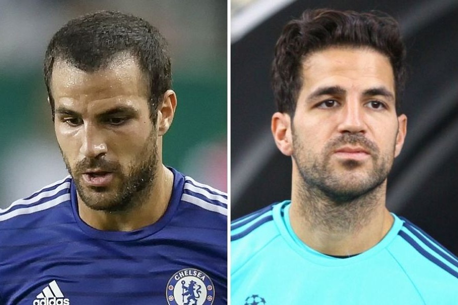 Cesc Fàbregas Hair Transplant