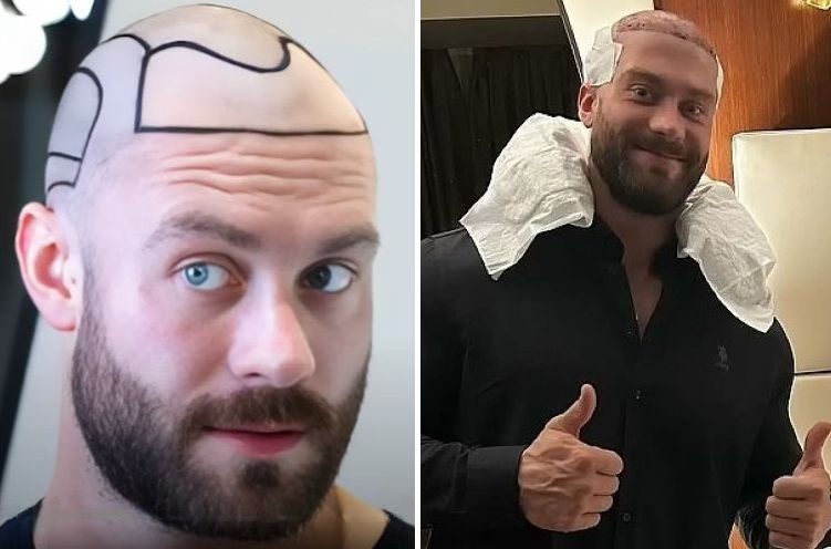 Chris Bumstead before and after his hair transplant