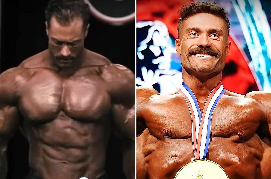 Chris Bumstead’s Hair Transplant - The Full Scoop
