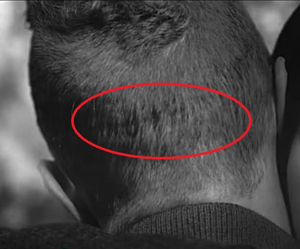 Chris Martin’s FUT scar