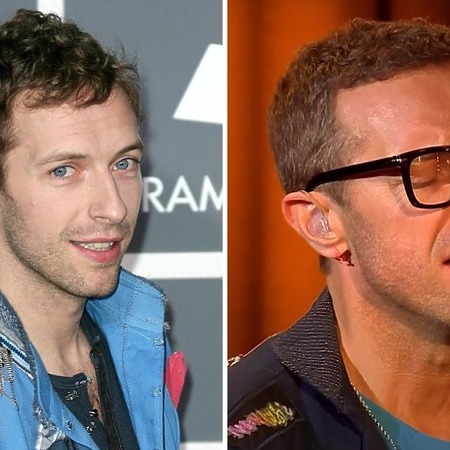 Chris Martin’s Hair Transplant: Are the Rumours True?