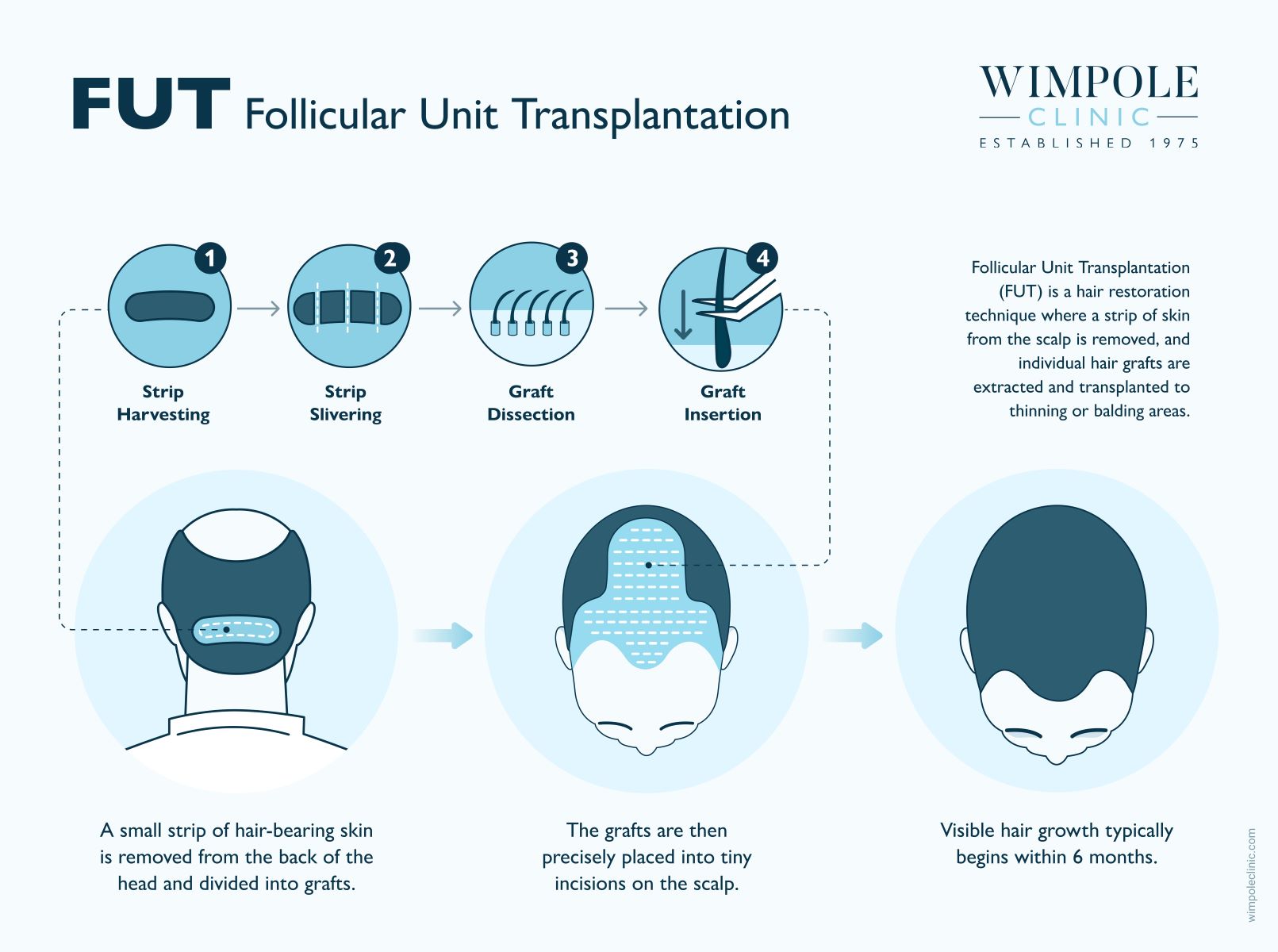 Follicular Unit Transplantation