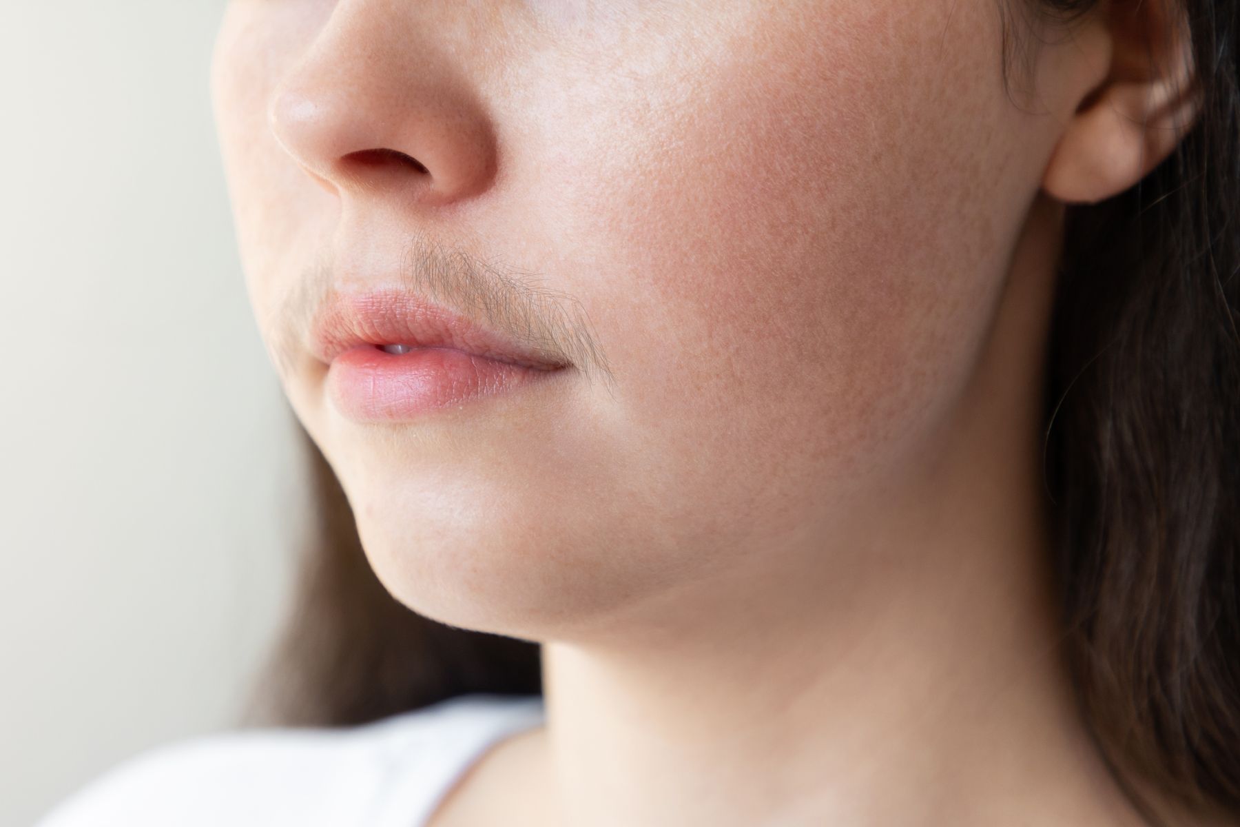 Hypertrichosis in women