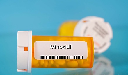 Is Oral Minoxidil Safe For Long-Term Use Against Hair Loss?