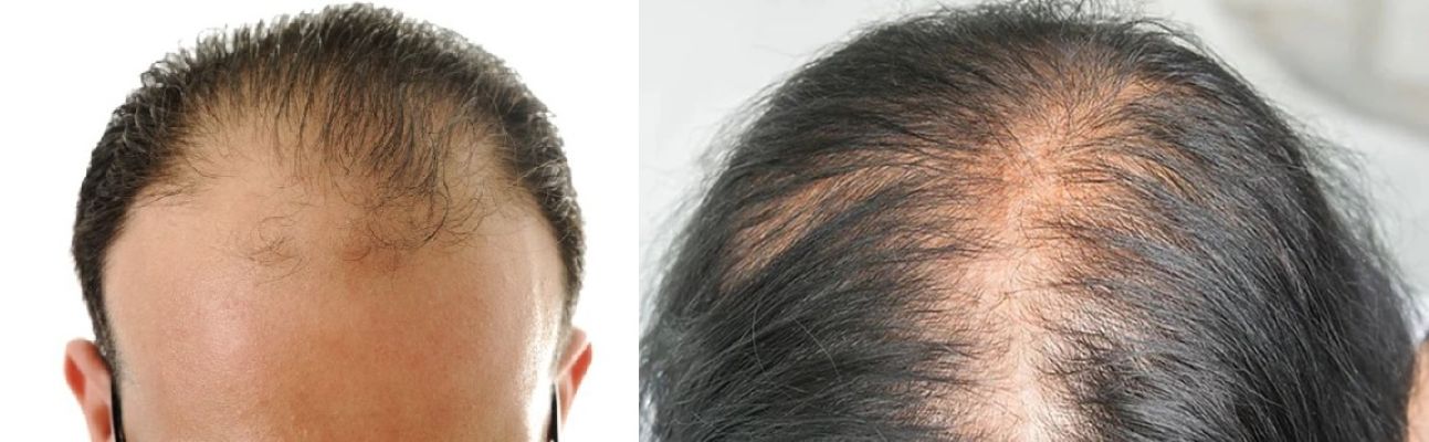 Man (left) and woman (right) with androgenetic alopecia)