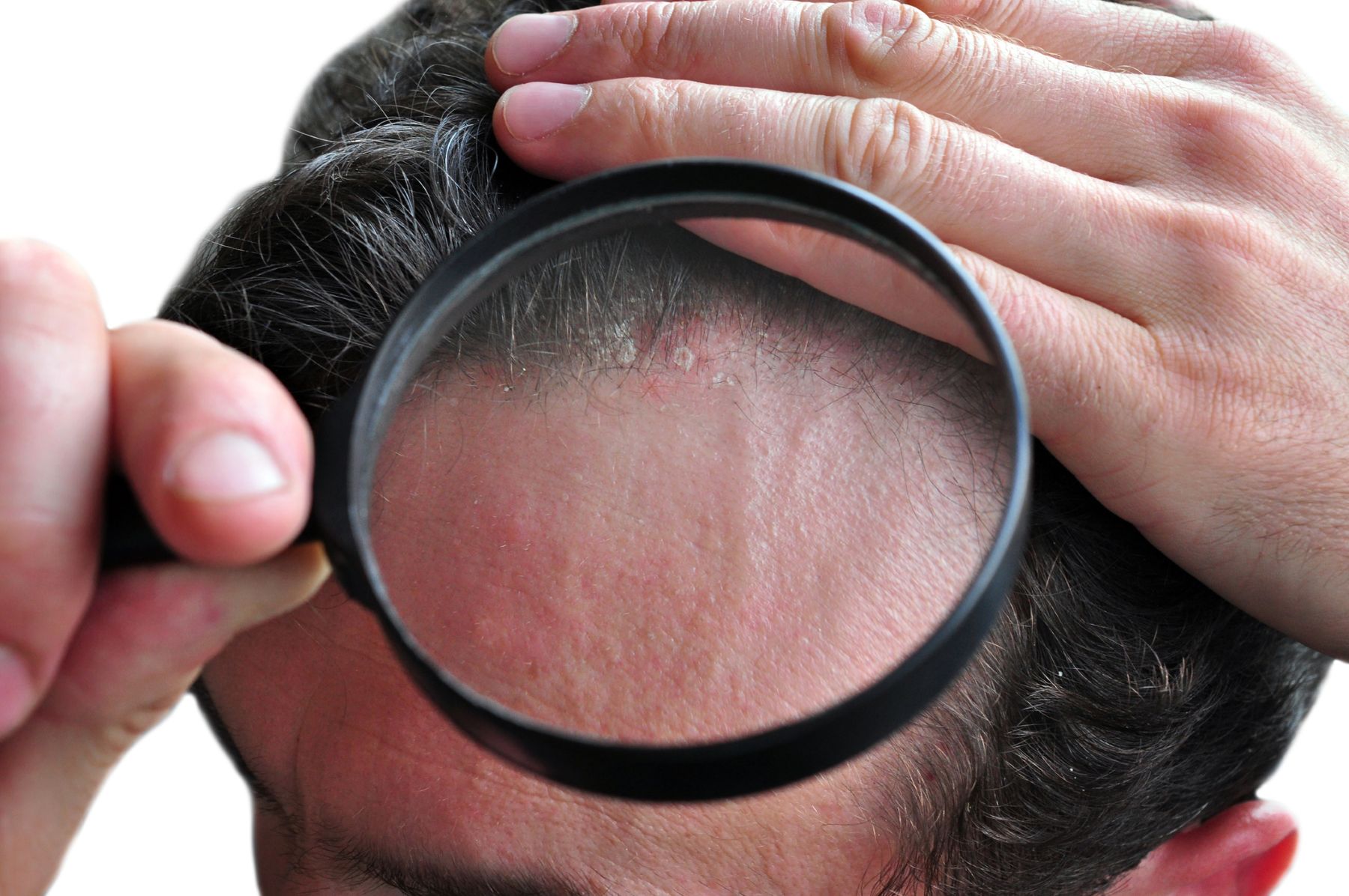 Men with an untreated scalp condition