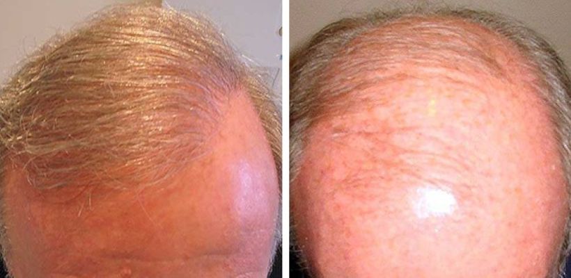 Norwood stage 6 hair transplant