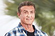 Celebrity Hair Transplant