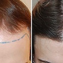 Transgender Hair Transplant: Benefits, Risks And Costs