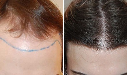 Transgender Hair Transplant