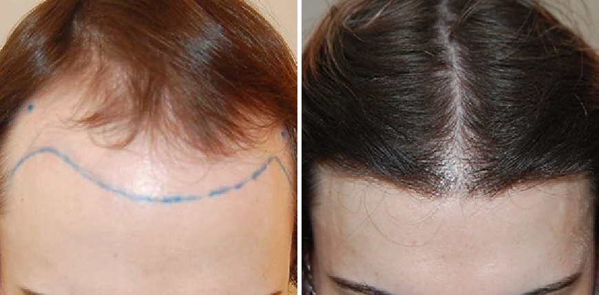 Transgender Hair Transplant