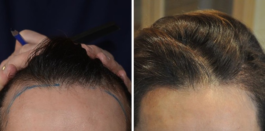 Transgender patient before and after hairline transplant