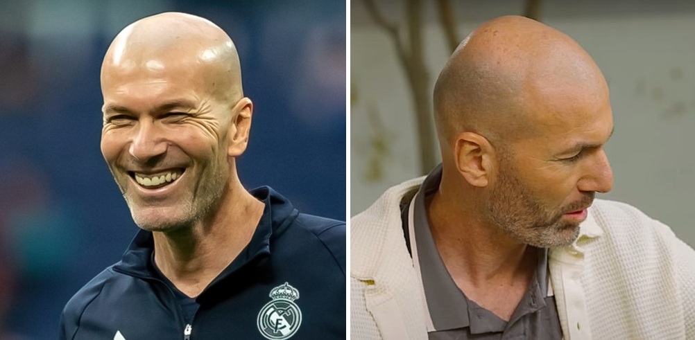 Zidane's hair loss in 2024