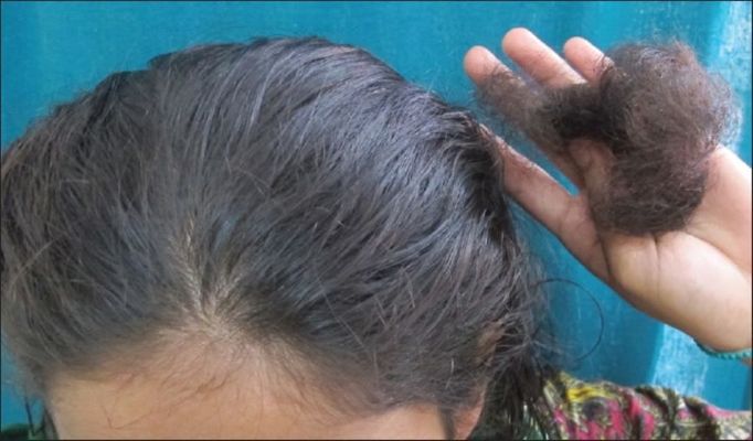 woman with postpartum hair loss
