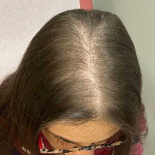 woman with stress-induced hair loss