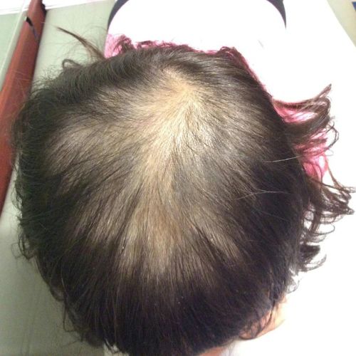 woman with thyroid hair loss