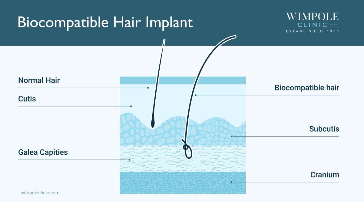 Biocompatible Hair Implant