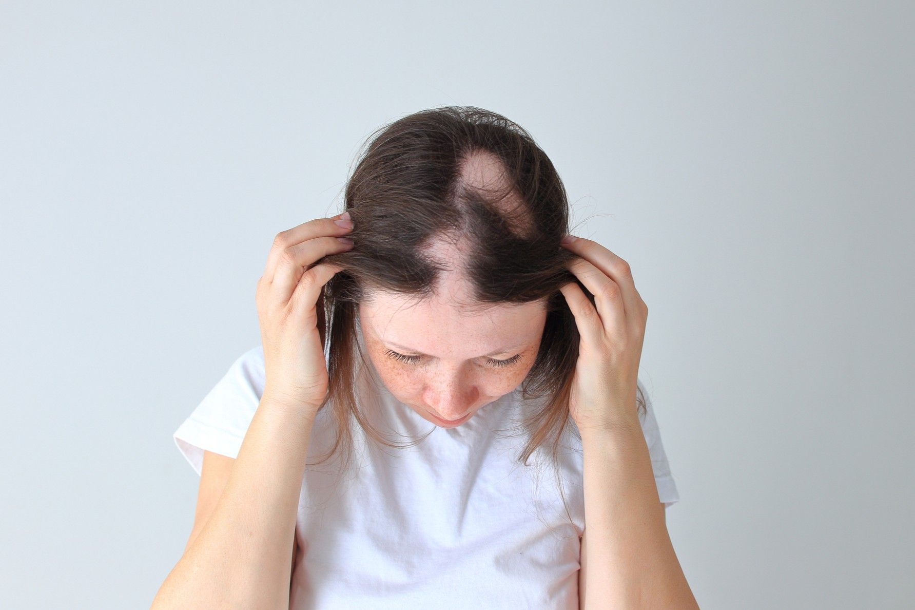 Why is my hair thinning at 25 female: alopecia areata