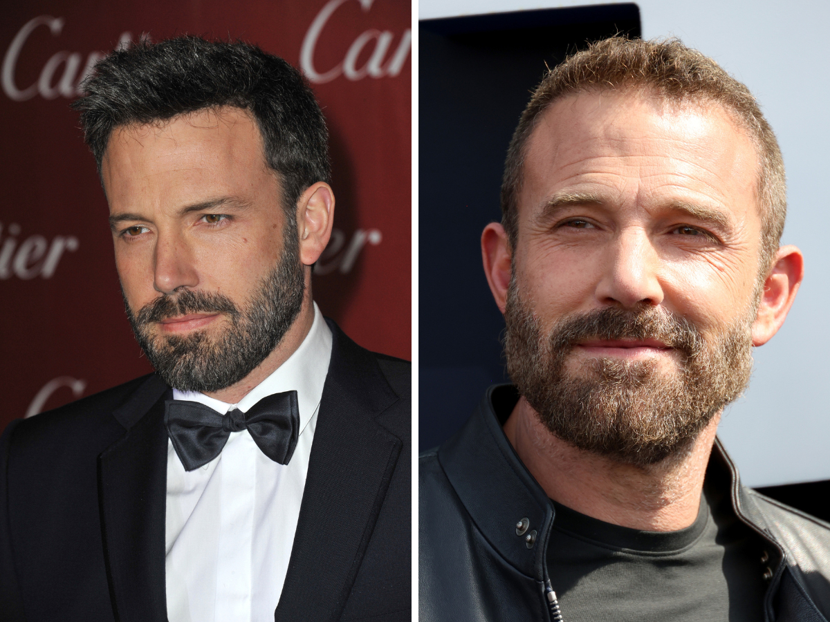 ben affleck hair transplant
