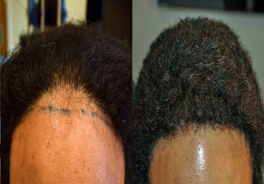 Afro Hair Transplant 500 grafts