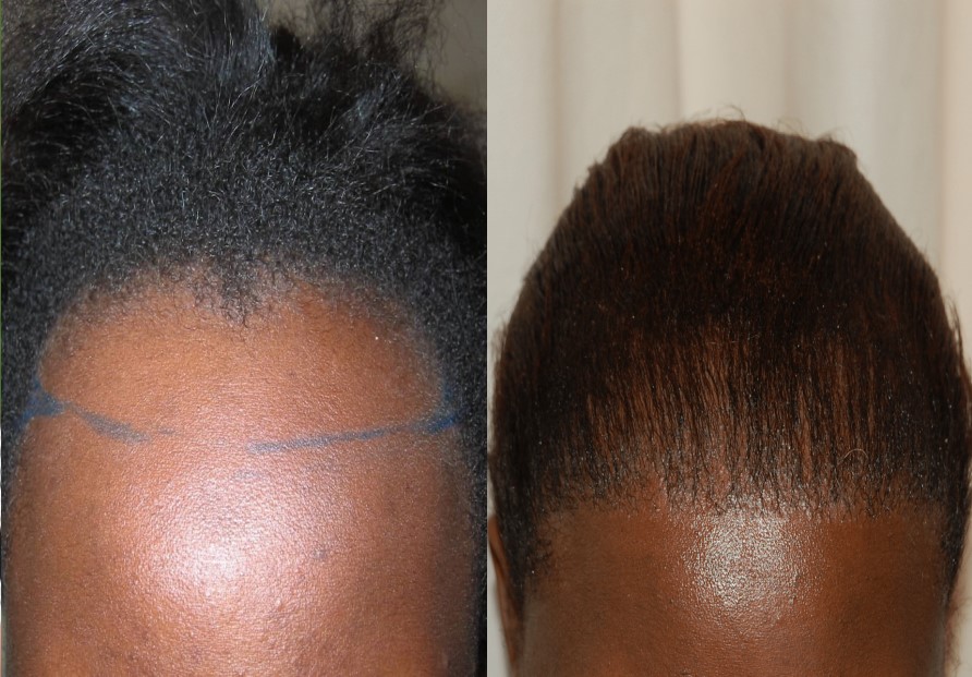 Afro Hair Transplant Result