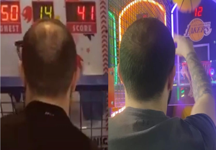Crown Transplant Result Before-After