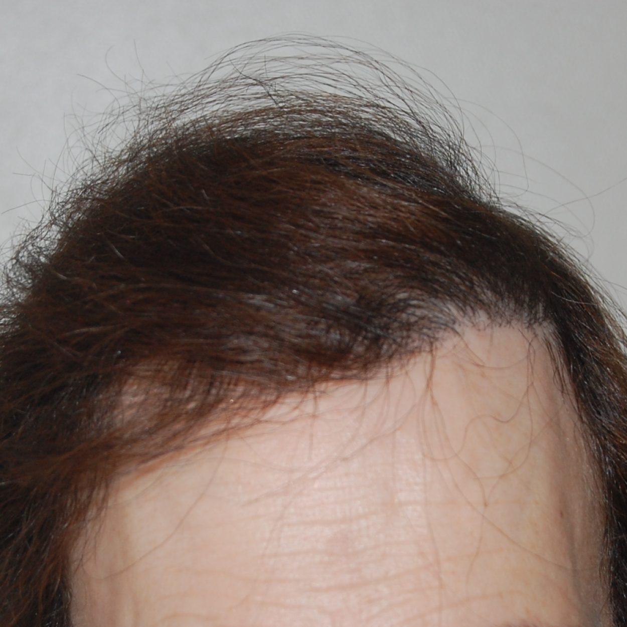 FUT After 4500 grafts