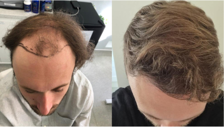 before and after male hair transplant results