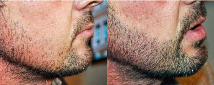 Before-after beard hair transplant surgery