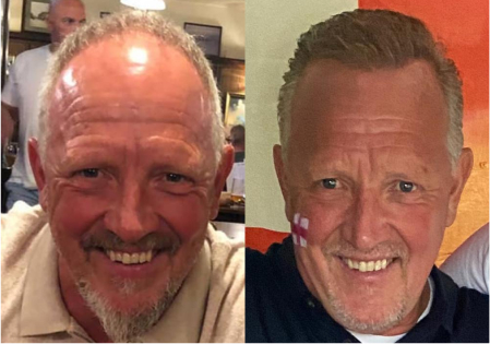 male hair transplant surgery before and after