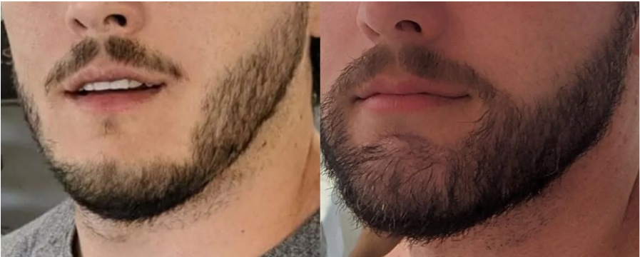 Before-after beard hair surgery