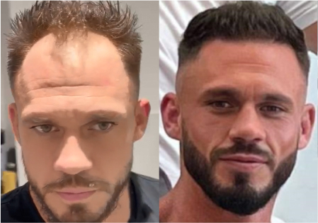 male hair transplant before and after