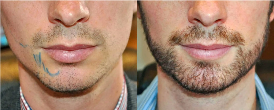 Before and after beard hair surgery