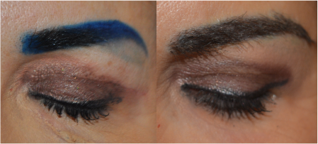 Eyebrow after transplant surgery