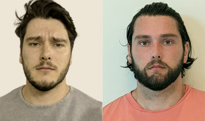 After beard hair transplant surgery