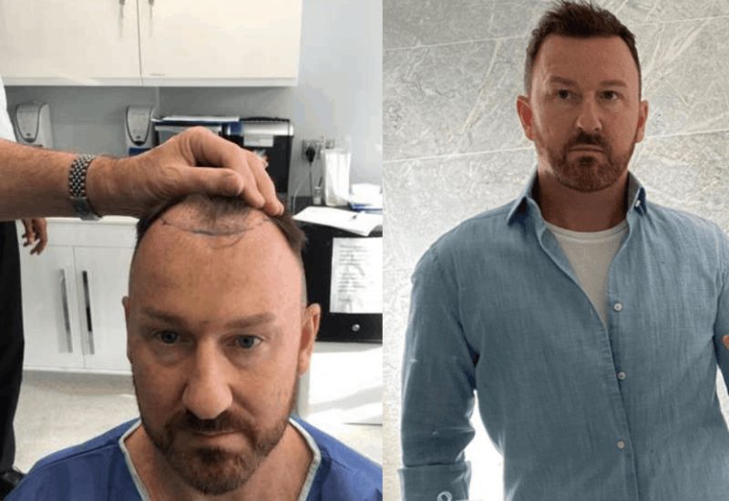 Johns FUE hair transplant results