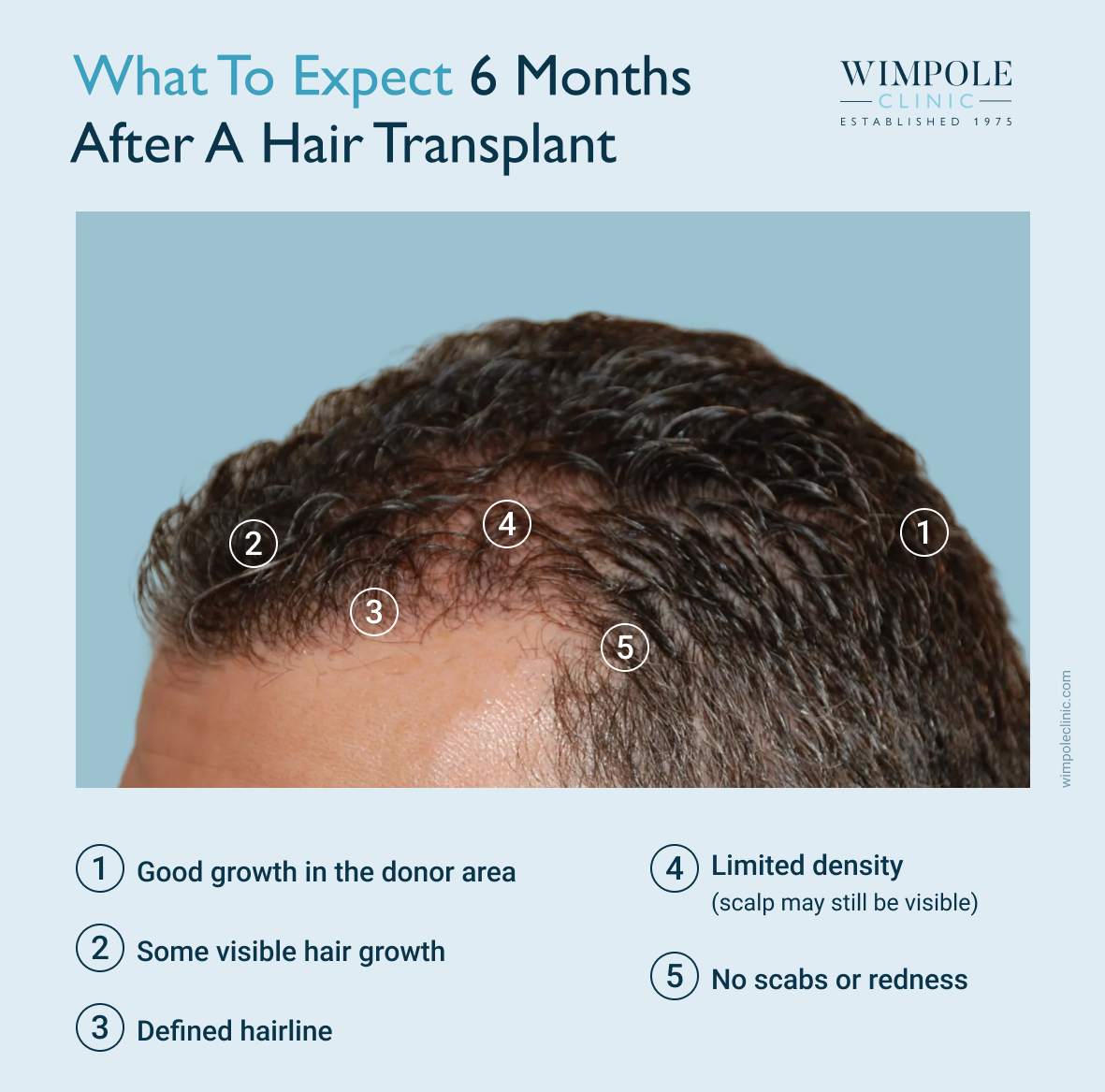 What to expect 6 months after a hair transplant