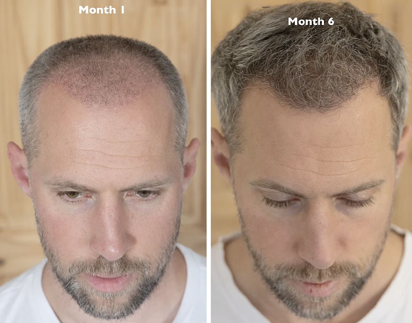 Wimpole Clinic patient Paul before and 6 months after his hair transplant
