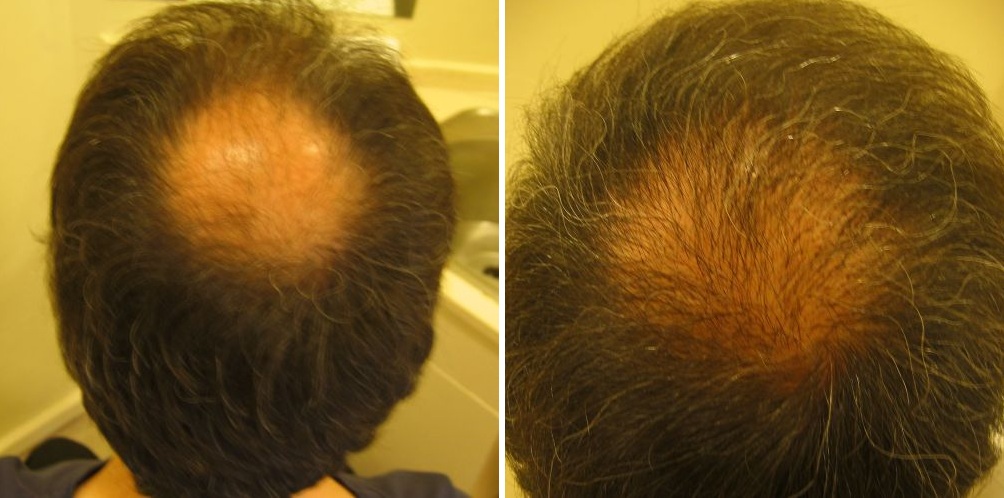 Wimpole patient's crown before and 6 months after hair transplant
