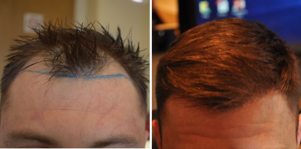 Wimpole patient's hairline before and 6 months after hair transplant