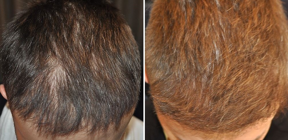 Wimpole patient's top of head before and 6 months after hair transplant